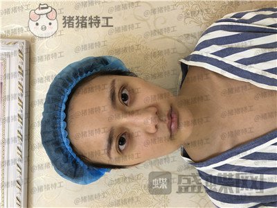 杭州伊琳,毛琪,面部填充,案例,价格,