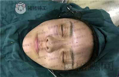 杭州伊琳,毛琪,面部填充,案例,价格,