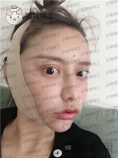 杭州伊琳,毛琪,面部填充,案例,价格,
