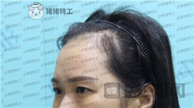 武汉中爱铭医,祁向峰,眼部手术,案例,价格,
