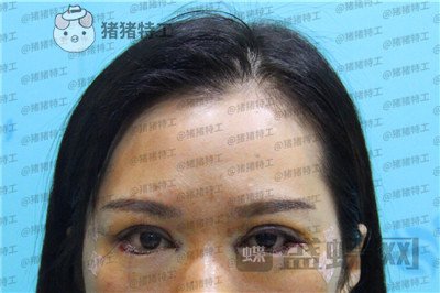 武汉中爱铭医,祁向峰,眼部手术,案例,价格,