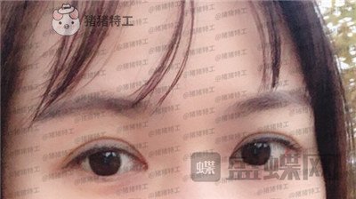 武汉中爱铭医,祁向峰,眼部手术,案例,价格,