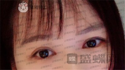 武汉中爱铭医,祁向峰,眼部手术,案例,价格,