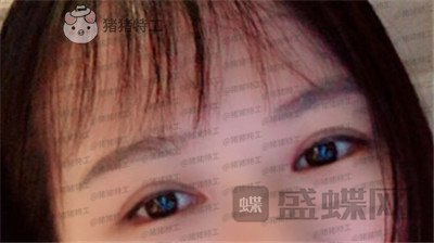 武汉中爱铭医,祁向峰,眼部手术,案例,价格,