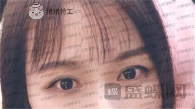 武汉中爱铭医,祁向峰,眼部手术,案例,价格,