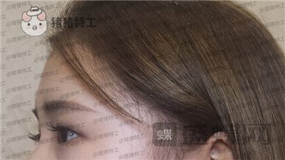 南京美贝尔,张永升,缩鼻翼,案例,价格,