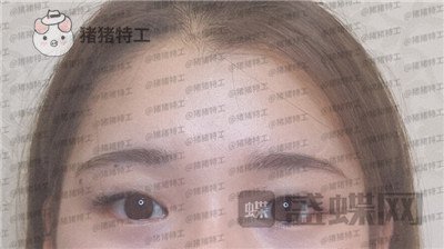 南京美贝尔,张永升,缩鼻翼,案例,价格,