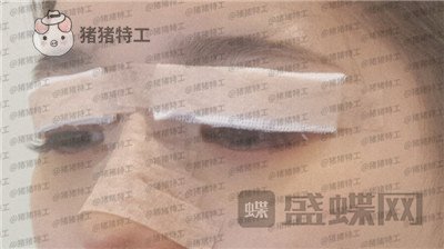 南京美贝尔,张永升,缩鼻翼,案例,价格,