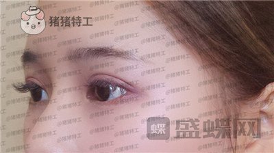 南京美贝尔,张永升,缩鼻翼,案例,价格,