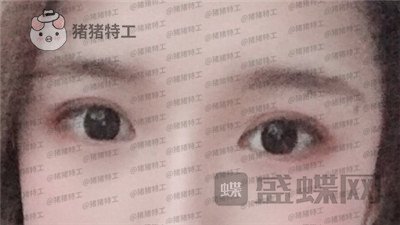 南京美贝尔,张永升,缩鼻翼,案例,价格,