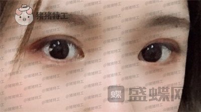 南京美贝尔,张永升,缩鼻翼,案例,价格,
