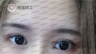 南京美贝尔,张永升,缩鼻翼,案例,价格,