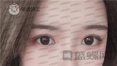 南京美贝尔,张永升,缩鼻翼,案例,价格,