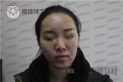 成都西区医院,车红昌,鼻部手术,案例,价格,