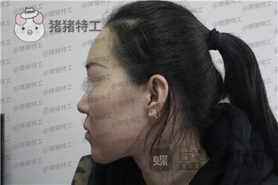成都西区医院,车红昌,鼻部手术,案例,价格,