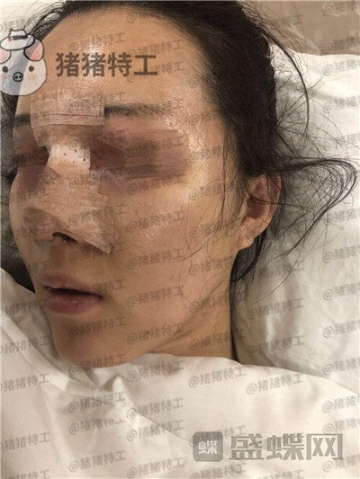 成都西区医院,车红昌,鼻部手术,案例,价格,