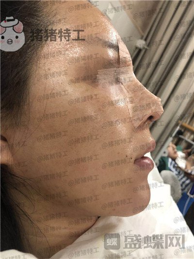成都西区医院,车红昌,鼻部手术,案例,价格,