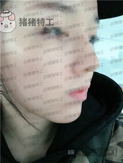 成都西区医院,车红昌,鼻部手术,案例,价格,