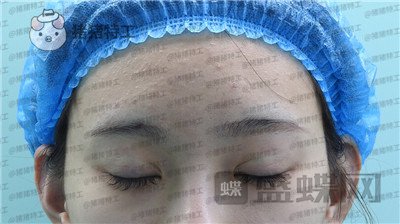 上海九院,王维,双眼皮,修复,案例,价格,