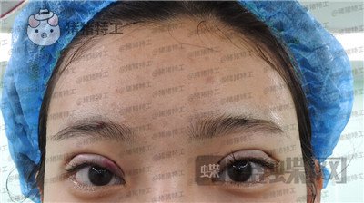 上海九院,王维,双眼皮,修复,案例,价格,