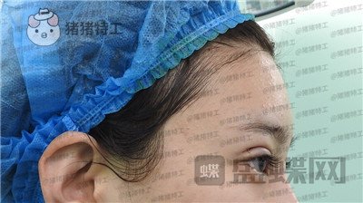 上海九院,王维,双眼皮,修复,案例,价格,