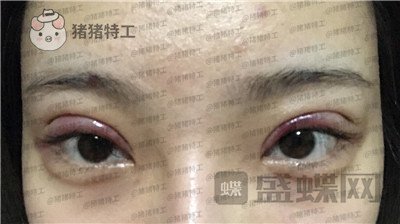 上海九院,王维,双眼皮,修复,案例,价格,
