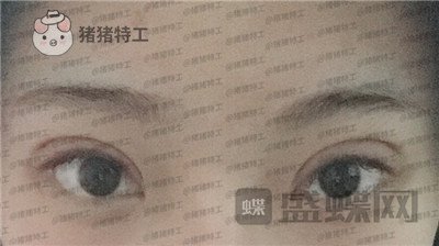 上海九院,王维,双眼皮,修复,案例,价格,