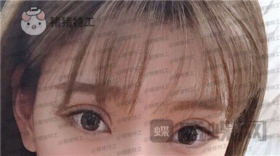 上海九院,王维,双眼皮,修复,案例,价格,