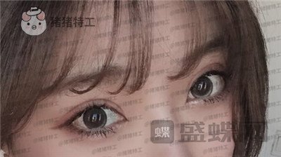 上海九院,王维,双眼皮,修复,案例,价格,