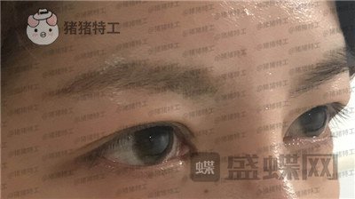 上海九院,苏婷,双眼皮修复,案例,价格,