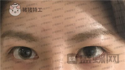 上海九院,苏婷,双眼皮修复,案例,价格,