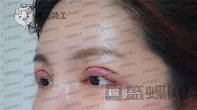 上海九院,苏婷,双眼皮修复,案例,价格,