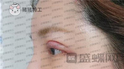 上海九院,苏婷,双眼皮修复,案例,价格,