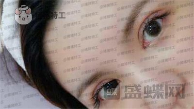 上海九院,苏婷,双眼皮修复,案例,价格,