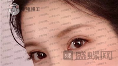 上海九院,苏婷,双眼皮修复,案例,价格,