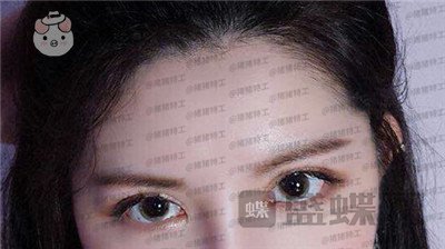 上海九院,苏婷,双眼皮修复,案例,价格,