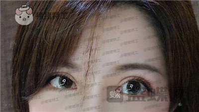 上海九院,苏婷,双眼皮修复,案例,价格,