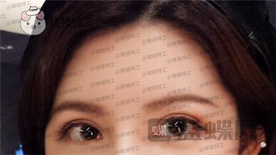 上海九院,苏婷,双眼皮修复,案例,价格,