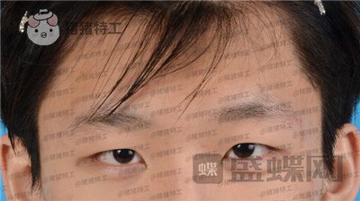 北京美莱,余辉,眼部手术,案例,价格,