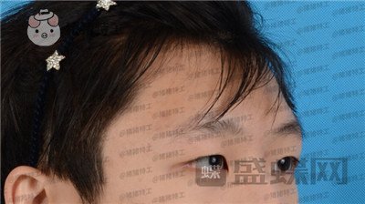 北京美莱,余辉,眼部手术,案例,价格,