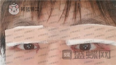 北京美莱,余辉,眼部手术,案例,价格,