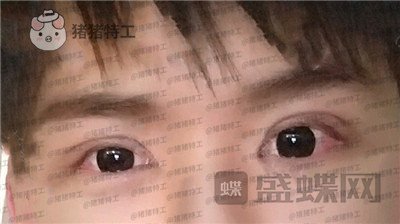 北京美莱,余辉,眼部手术,案例,价格,
