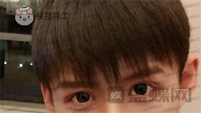 北京美莱,余辉,眼部手术,案例,价格,