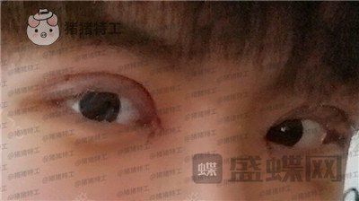 北京美莱,余辉,眼部手术,案例,价格,