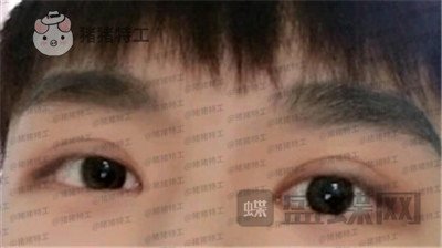 北京美莱,余辉,眼部手术,案例,价格,