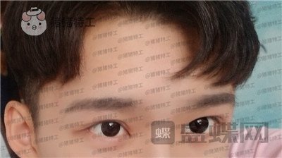 北京美莱,余辉,眼部手术,案例,价格,