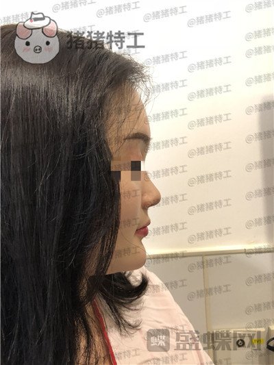 上海百达丽,原九院,沈国雄,隆鼻,案例,价格,