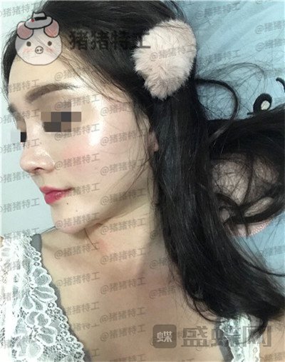 上海百达丽,原九院,沈国雄,隆鼻,案例,价格,