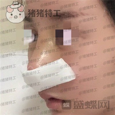 北京八大处,王欢,鼻修复,案例,价格,