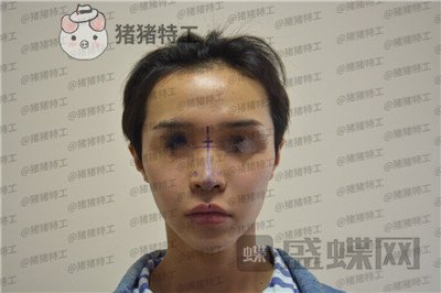 成都西区医院,车红昌,鼻部手术,案例,价格,